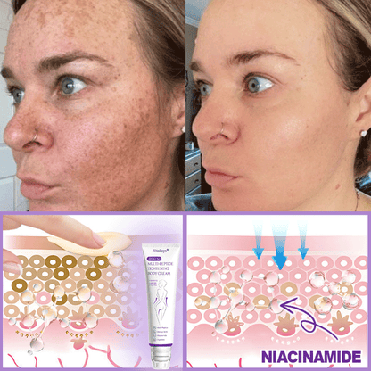 💕 Vitalisys® PDRN Multi-Peptide Massaging Body Roller Cream- Anti-aging, Hydrating, Skin Firming & Lifting, Skin Repair, Even Tone, Acne and Dark Spot Treatment, Wart and Mole Removal, and Psoriasis Relief