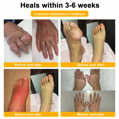 30% OFF 🎁🎁 | 𝐌𝐔𝐑𝐖𝐎𝐍® Bee Venom Balm for Pain Relief & Bone Healing ✨