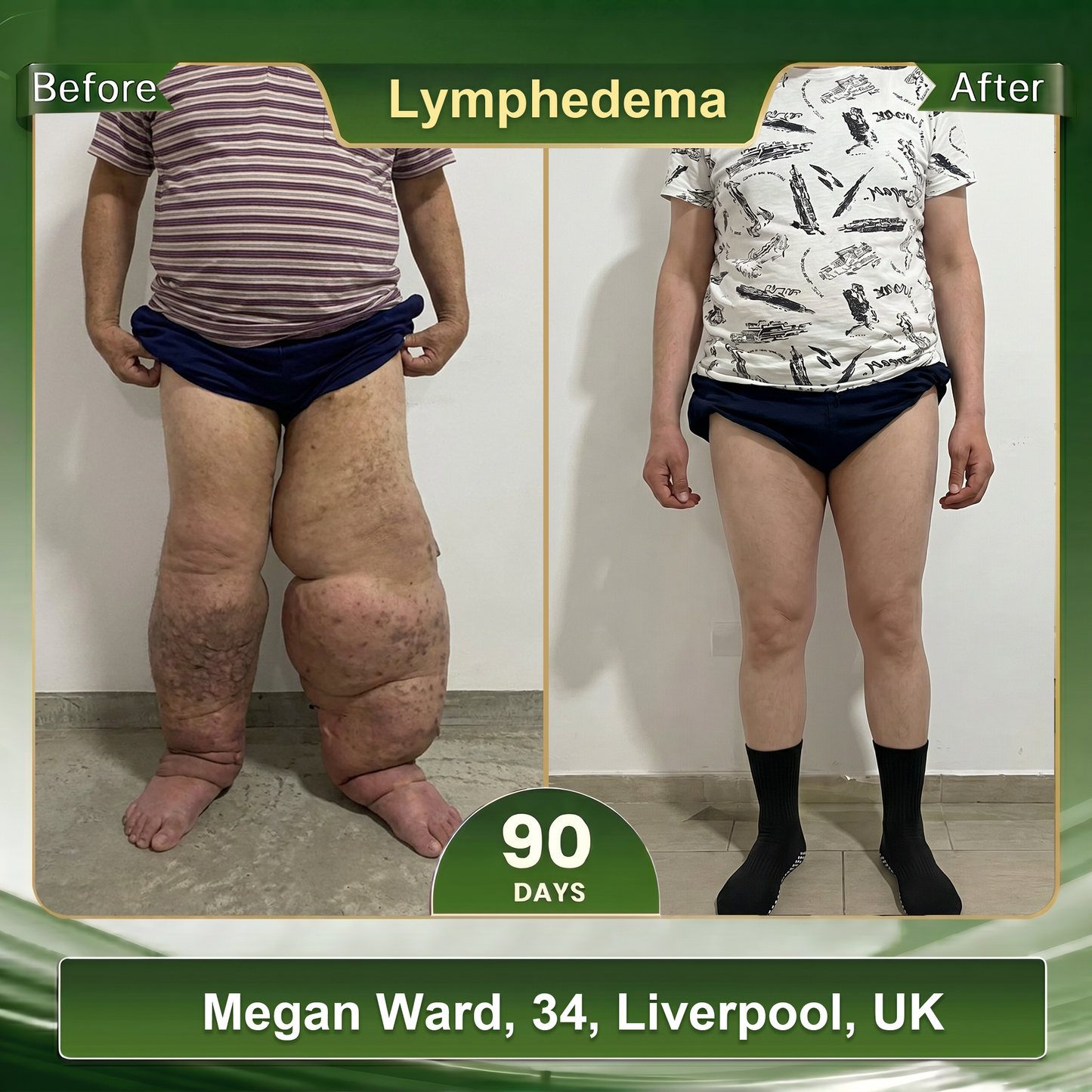 𝗢𝗳𝗳𝗶𝗰𝗶𝐚𝐥 𝐒𝐭𝐨𝐫𝐞 🎗️|🌟 𝑩𝑳𝑼𝑬𝙎𝙃𝓞𝑻® 𝟐𝟎𝟐𝟔 10 𝒊𝒏 1 𝑪𝒖𝒕𝒕𝒊𝒏𝒈 𝒆𝒅𝒈𝒆 𝒊𝒐𝒏 𝒕𝒉𝒆𝒓𝒎𝒂𝒍 𝒔𝒉𝒂𝒑𝒊𝒏𝒈 𝒔𝒐𝒄𝒌𝒔| Specially designed to solve deep lymphedema and relieve varicose veins, the thigh is thick and robust | 7-Day Intensive Sculpting Protocol