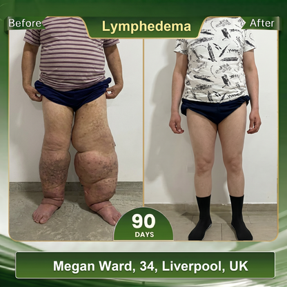 𝗢𝗳𝗳𝗶𝗰𝗶𝐚𝐥 𝐒𝐭𝐨𝐫𝐞 🎗️|🌟 𝑩𝑳𝑼𝑬𝙎𝙃𝓞𝑻® 𝟐𝟎𝟐𝟔 10 𝒊𝒏 1 𝑪𝒖𝒕𝒕𝒊𝒏𝒈 𝒆𝒅𝒈𝒆 𝒊𝒐𝒏 𝒕𝒉𝒆𝒓𝒎𝒂𝒍 𝒔𝒉𝒂𝒑𝒊𝒏𝒈 𝒔𝒐𝒄𝒌𝒔| Specially designed to solve deep lymphedema and relieve varicose veins, the thigh is thick and robust | 7-Day Intensive Sculpting Protocol